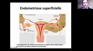 15/04/2021	10:00	12:00	Fibromes, Endométriose	VINCENS Claire	308	2366652513	MIE