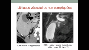 DFASM1 MIB L Piron M Hermida Lithiase biliaire et complications, N° 320 - Ictère diagnostic 01/10/2020