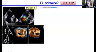 Evaluation de la valve tricusoide ETT et ETO - Dr SPORTOUCH - Trim.mp4