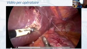 DU PEC_des Patients atteints d'obésité sévère ou massive_PART 4/4_15092023