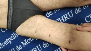 DU DLM Membres Inférieurs : Segmtaire cuisse