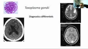 Module 2 : Traitement de l’infection VIH et des infections opportunistes