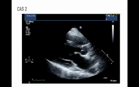 Fuites Mitrales - cas cliniques - Indications thérapeutique - Dr SOULLIER