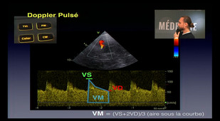 Doppler trans-crânien