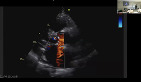 PR BOBBIA ECHO CARDIAQ ET PERICARDIAQUE 2.mp4