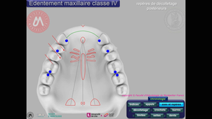 Tracé maxillaire classe IV vitesse accélérée 4 fois