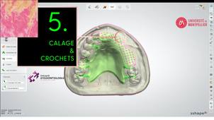 3SHAPE2025_PPAM MX 05 calage & crochets.mp4
