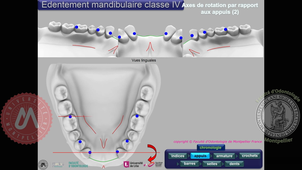 Tracé classe IV mandibulaire