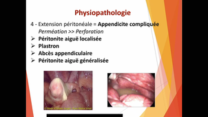 DFGSM2 Garnier Appendicite Aiguë
