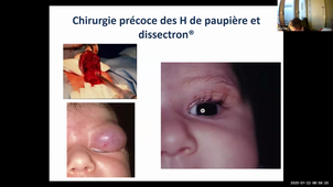 DU CPP - Pr.Soupre - Anomalies vasculaires des téguments