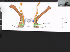 06-03-24-DFGSM2-Appareil rénal-CM5-M Bertrand.mp4