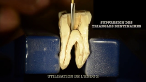 Traitement endodontique sur molaire
