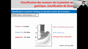 13/04/2021	11:00	13:00	Tumeurs de l'estomac et de l'œsophage	FR. SOUCHE	
