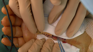 Chirurgie du syndrome du canal carpien à ciel ouvert