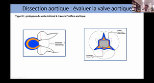 ETO et pathologie aortique- Dr ARREGLE.mp4