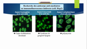 DFASM2 MIF 13/11/2020 VINCENT T. - LUKAS C. / Lupus érythémateux disséminé, syndrome des anti-phospholipides; pathologies auto-immunes