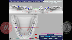 Tracé classe IV mandibulaire (vitesse accélérée)