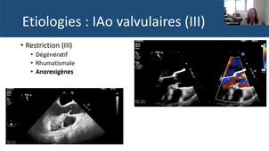 Dr CONTE - Insuffisance aortique- anatomie mecanismes étiologies.mp4