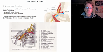 Sd défilé cervico-thoraco-brachial