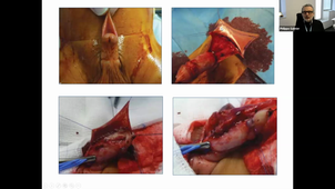 Malformation des OGE - Pr Galinier (DUC de CPP) (04/12/2020)