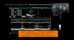 Echocardiographie transthoracique