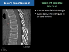 Trauma rachis dorsolombaire - VIALA 2015