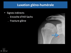 Traumatismes osseux et lésions sentinelles A Larbi