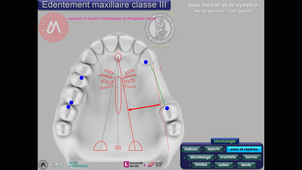 Tracé maxillaire classe III vitesse accélérée