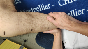 DU DLM Membres Inférieurs : Segmtaire jambe pied