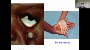 Pathogenesis of severe malaria - Polrat - 2-09-2026.mp4