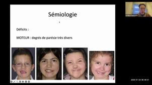 DU CPP - Pr.Guerreschi - Paralysie faciale de l'enfant