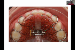 DU de chirurgie plastique pédiatrique Dr Rotemberg, Orthodontie et fentes labiales et palatines 03/12/2020