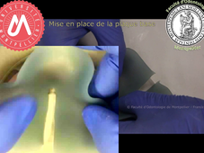 J4d_PEI mandibulaire totalement espacé_plaque base