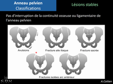 Traumatisme du bassin