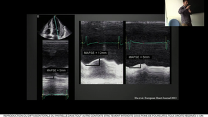 DIU TMUS / Dr Bobbia Synthèse hémodynamique