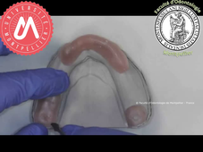 J3c_PEI mandibulaire partiellement ajusté_butées d'enfoncement