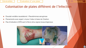 e-learning : Plaie et peau en cancérologie - Dr Charlée Nardin, CHU Besançon