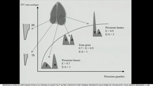 DIU TMUS / Dr Muller Echographie cardiaque et péricardique 2