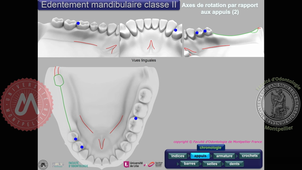 Tracé classe II mandibulaire (vitesse accélérée)