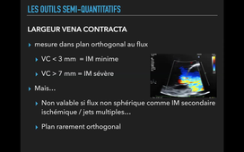 Fuite Mitrale - quantification - Dr SOULLIER