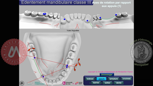 Tracé classe III mandibulaire