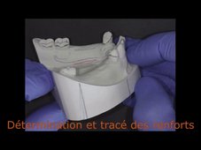 L4 * LIMITES POSTERIEURES, RENFORTS & CROCHETS