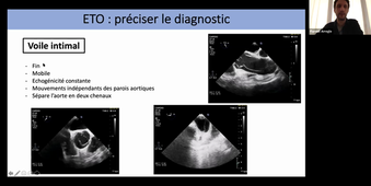 ETO et pathologie aortique - Dr ARREGLE