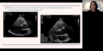 Evaluation Echographie des cardiomyopathies hypertrophiques - Dr SOULLIER