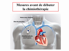 Chimiothérapie