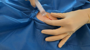 Anesthésie suture