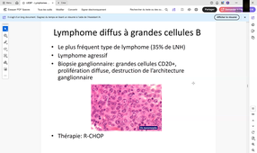 Pathologies malignes lymphoïdes - Dr C. Bagacean (Brest).mp4