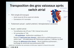 CAT devant un coeur droit dilaté_Pr MOCERI.mp4