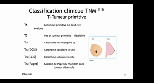 Classe virtuelle - Cancer du sein-Sémiologie et stratégie thérapeutique (Dr M. UNG, CHU Toulouse)