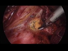 VIDEO COURS CHIRURGIE MINI-INVASIVE CANCER DE L'OESOPHAGE